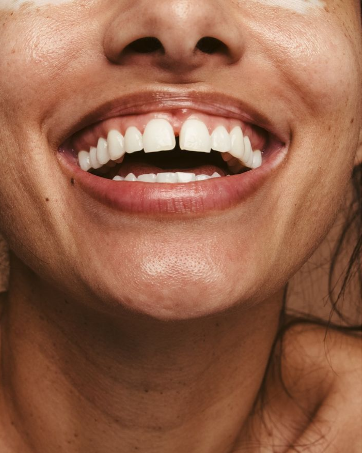 teeth spacing