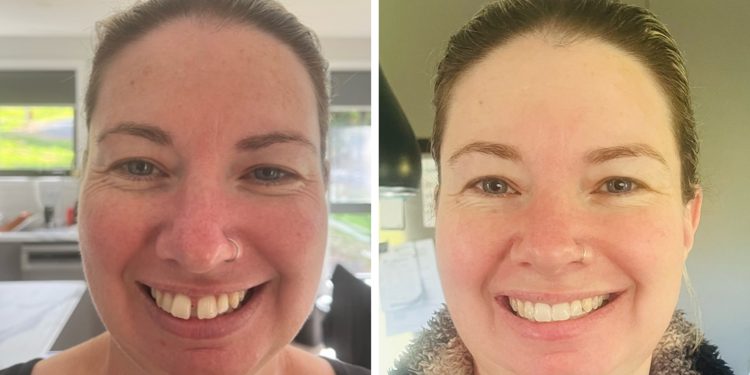 Straighter Smile Made Easy | Boost Confidence with Aalto Aligners