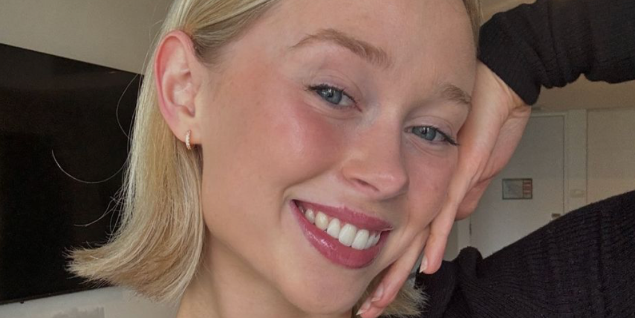 How to Fix an Overbite | Clear Aligner Treatment Guide