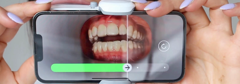 Remote Dental Monitoring with Aalto | Track Your Orthodontic Progress