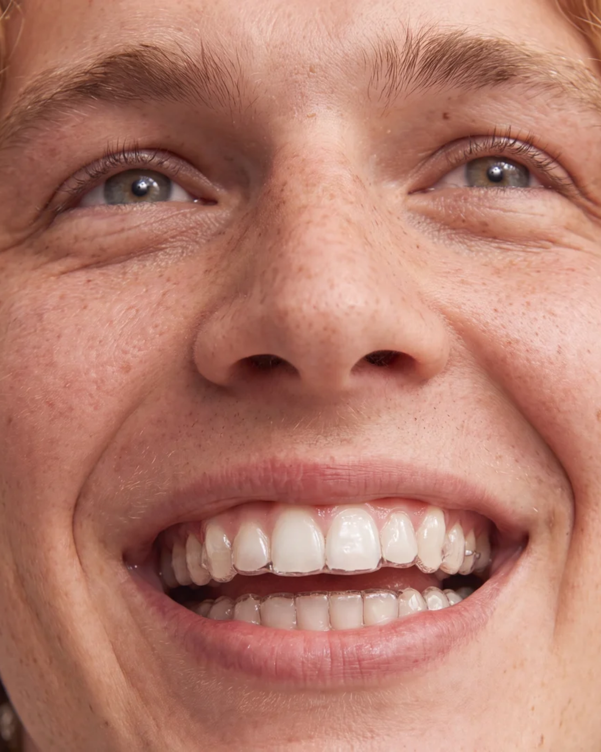 clear aligners