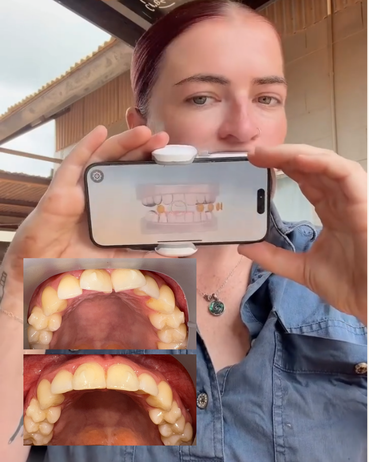 Sienna Mallon’s Aalto Smile Transformation