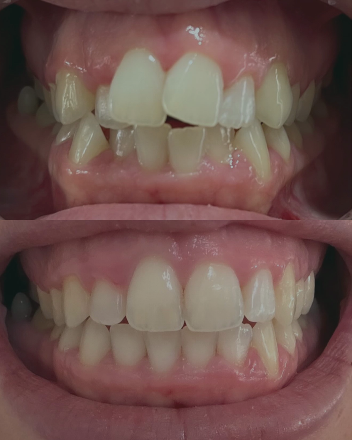 Clear Aligner Before and After Results