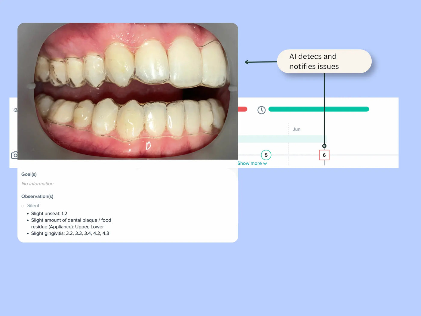 Aligner fit