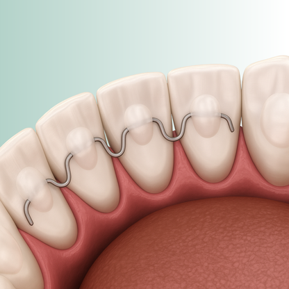 Permanent Retainers